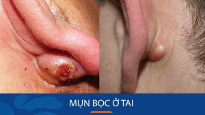 Mụn bọc ở tai – Nỗi ám ảnh và cách đánh bay hiệu quả