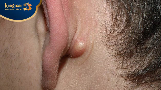 Có nhiều nguyên nhân gây mụn bọc ở tai