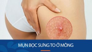 Mụn bọc sưng to ở mông: Giải mã nguyên nhân và cách trị dứt điểm