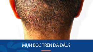 Mụn bọc trên da đầu: Nguyên nhân và cách điều trị triệt để