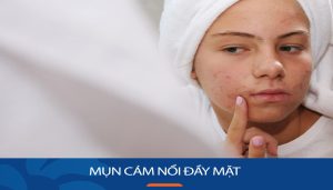 Mụn cám NỔI ĐẦY MẶT: Bí quyết LOẠI BỎ HIỆU QUẢ TẠI NHÀ