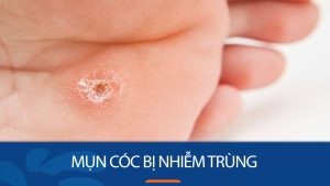 Mụn cóc bị nhiễm trùng: Nguyên nhân, triệu chứng và cách điều trị