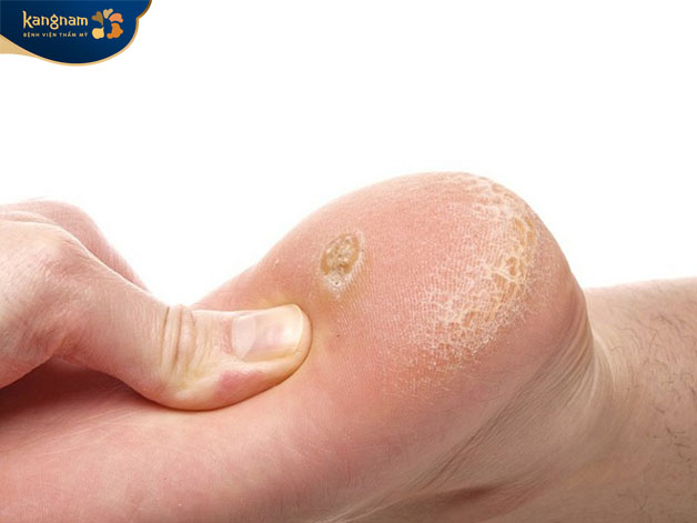 Những nốt mụn cóc ở bàn chân chịu áp lực nên mang đến cảm giác đau nhức