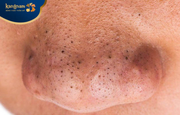 Nặn mụn đầu đen không điều trị tận gốc