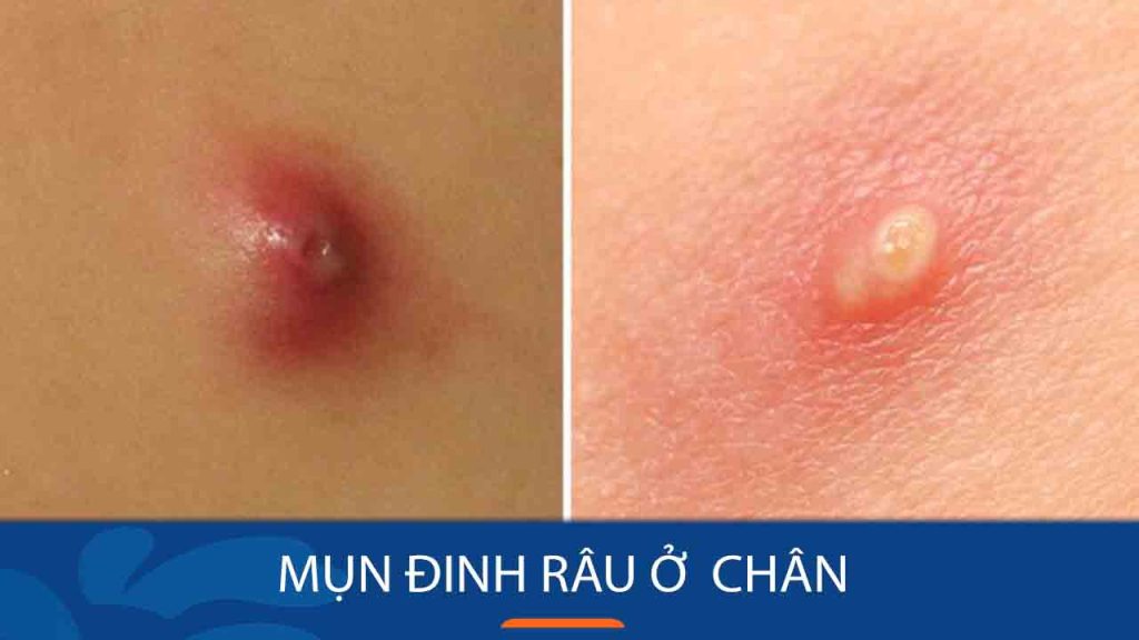 Mụn đinh râu ở chân – Nguy cơ tiềm ẩn và cách phòng ngừa hiệu quả