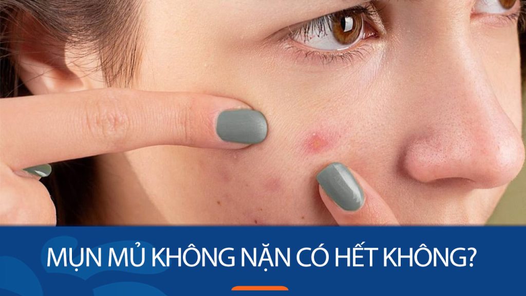 Mụn mủ không nặn có hết không? Bí quyết nặn mụn an toàn, không sẹo