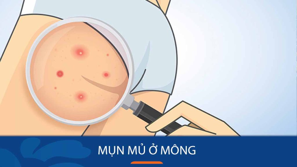 Bị mụn mủ ở mông? Đừng lo, đã có cách nặn mụn an toàn và hiệu quả