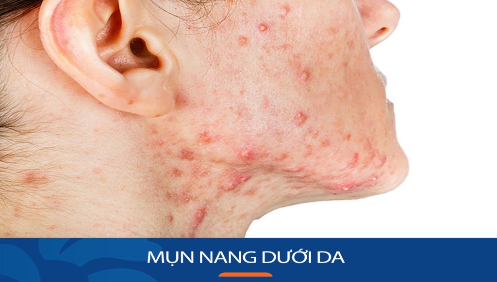 Mụn nang dưới da: Nguyên nhân, triệu chứng và cách điều trị
