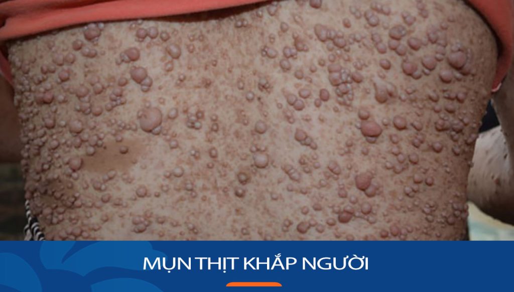 Cách loại bỏ mụn thịt khắp người hiệu quả và an toàn