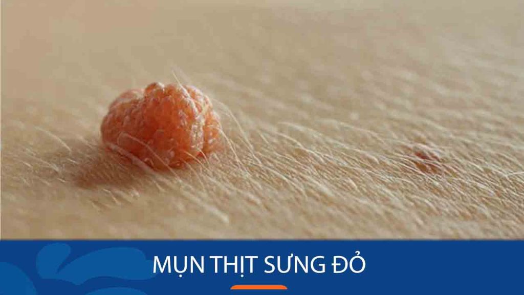 Bí quyết đánh bay mụn thịt sưng đỏ chỉ sau 7 ngày