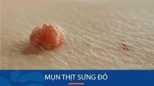 Bí quyết đánh bay mụn thịt sưng đỏ chỉ sau 7 ngày