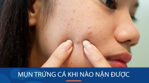 Mụn trứng cá khi nào nặn được?Nặn mụn trứng cá đúng thời điểm: Chìa khóa cho làn da sáng mịn