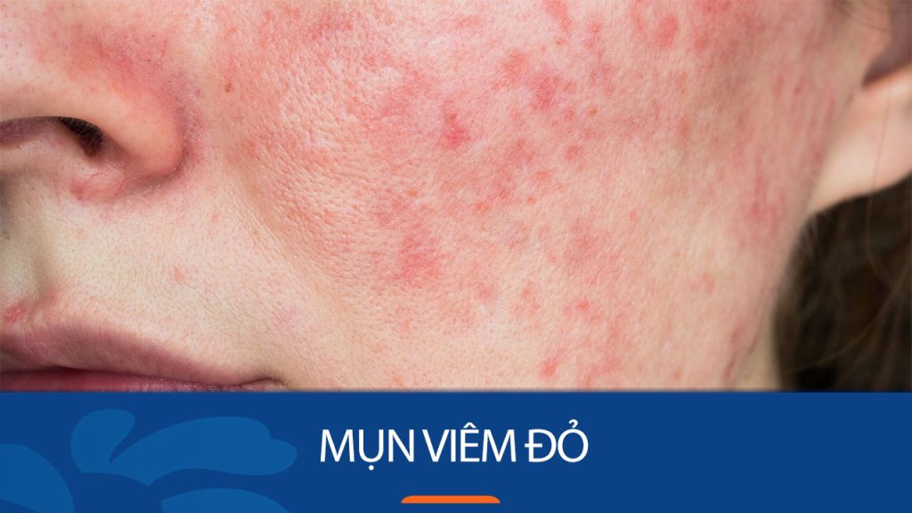 Bí quyết loại bỏ mụn viêm đỏ và thâm sẹo nhanh chóng