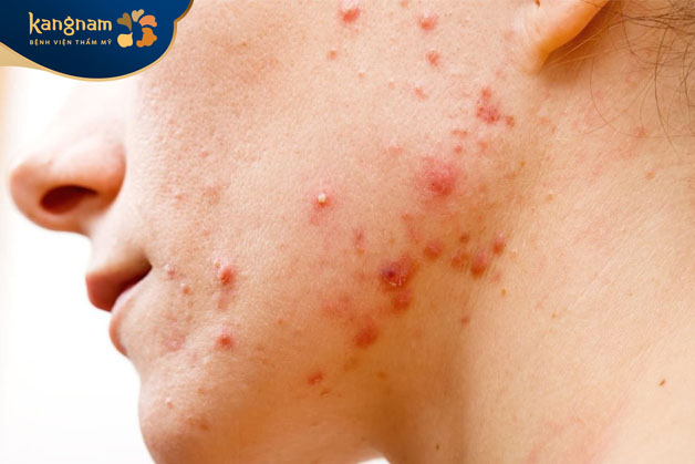 Mụn viêm sưng đỏ có đặc điểm đặc trưng là sưng to nổi lên trên bề mặt da