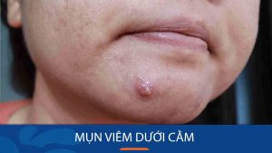 Mụn viêm dưới cằm: Nguyên nhân, triệu chứng và cách điều trị