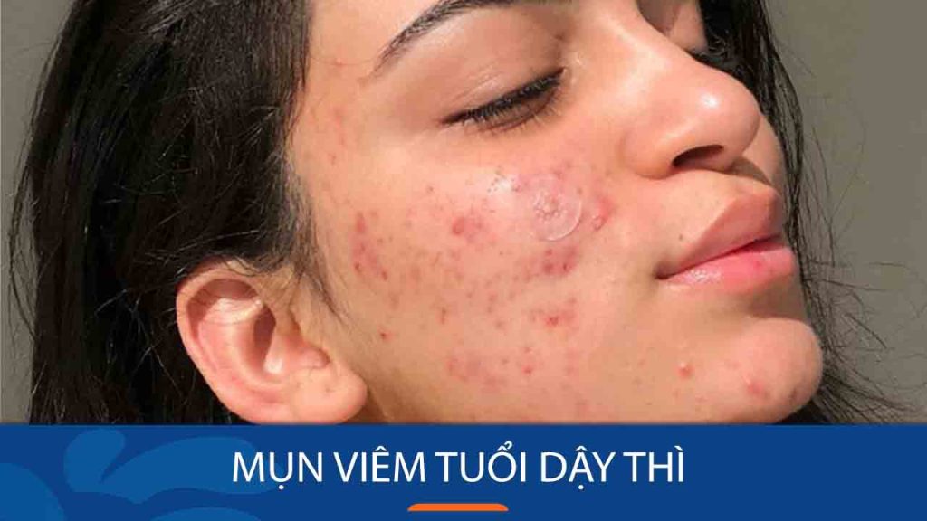 Bí quyết dẹp tan mụn viêm tuổi dậy thì chỉ trong 7 ngày