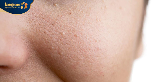 Mụn ẩn nằm sâu dưới da nên khi nặn không đúng cách sẽ khiến vi khuẩn xâm nhập vào sâu trong lỗ chân lông 