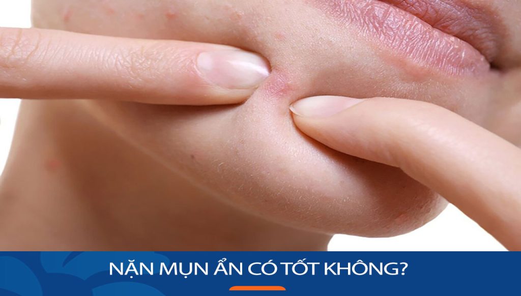 Nặn mụn ẩn có tốt không? Bí quyết để có làn da sáng mịn