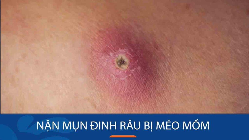 Nặn mụn đinh râu bị méo mồm: Nguyên nhân, cách điều trị và phòng ngừa