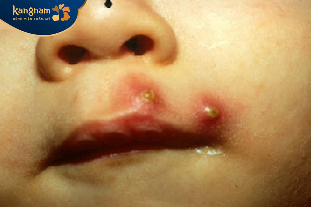 mụn đinh râu quanh miệng là do nhiễm khuẩn tại nang lông