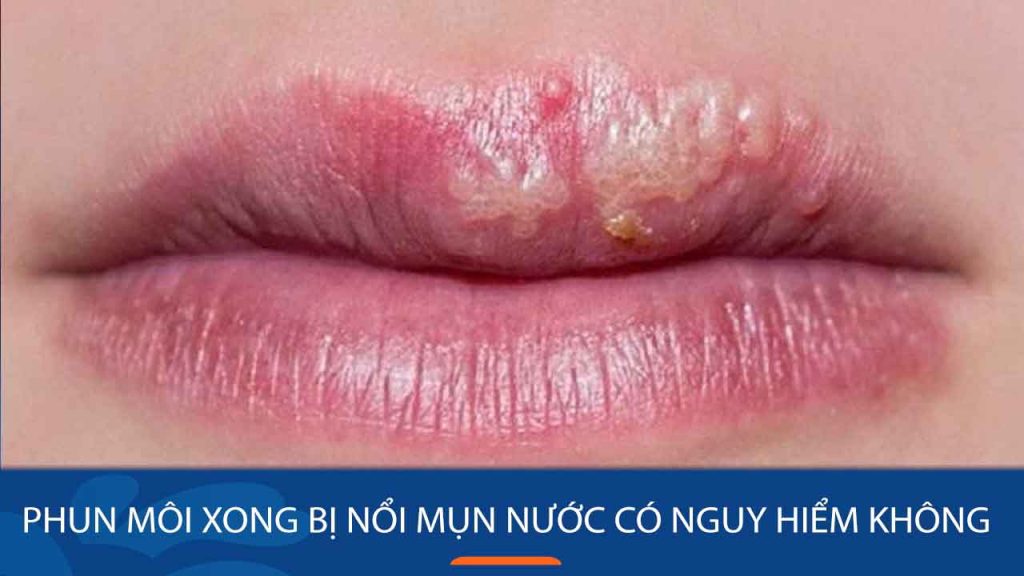 Phun môi xong bị nổi mụn nước có nguy hiểm không?Những lưu ý