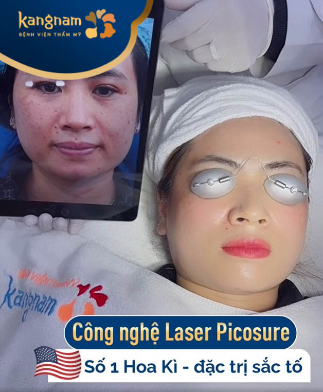 Laser Picosure là công nghệ điều trị tàn nhang được ứng dụng phổ biến bởi hiệu quả cao, an toàn