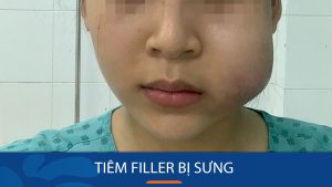 Tại sao tiêm filler bị sưng? Giải pháp giảm sưng nhanh chóng và an toàn