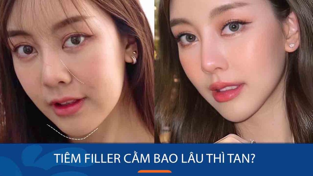 Tiêm filler cằm bao lâu thì tan? Lưu ý gì trước khi tiêm?