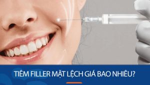 Tiêm filler mặt lệch giá bao nhiêu? Bảng giá chi tiết và cập nhật mới nhất 2024