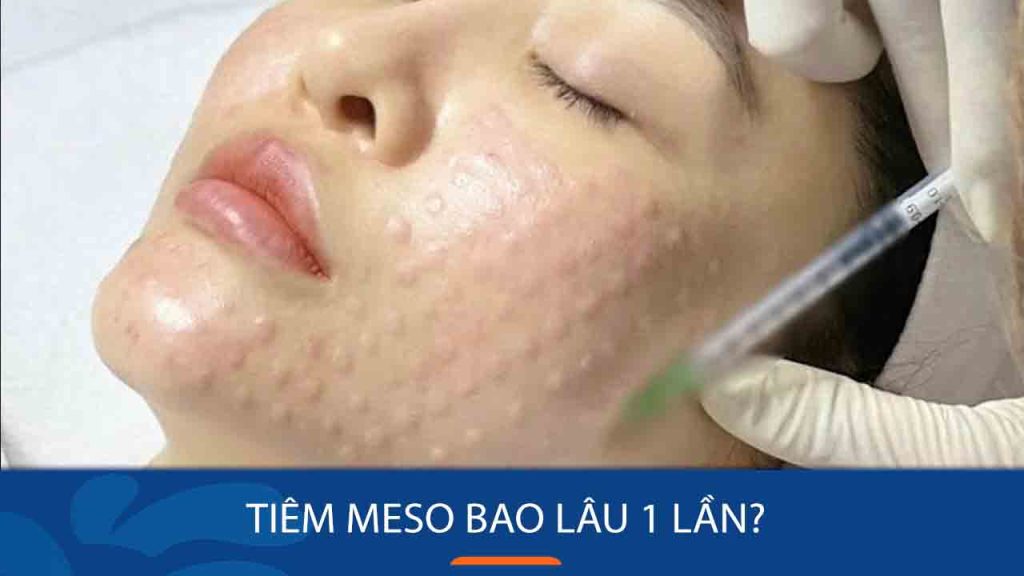 Tiêm meso bao lâu 1 lần? Cách duy trì hiệu quả sau tiêm meso