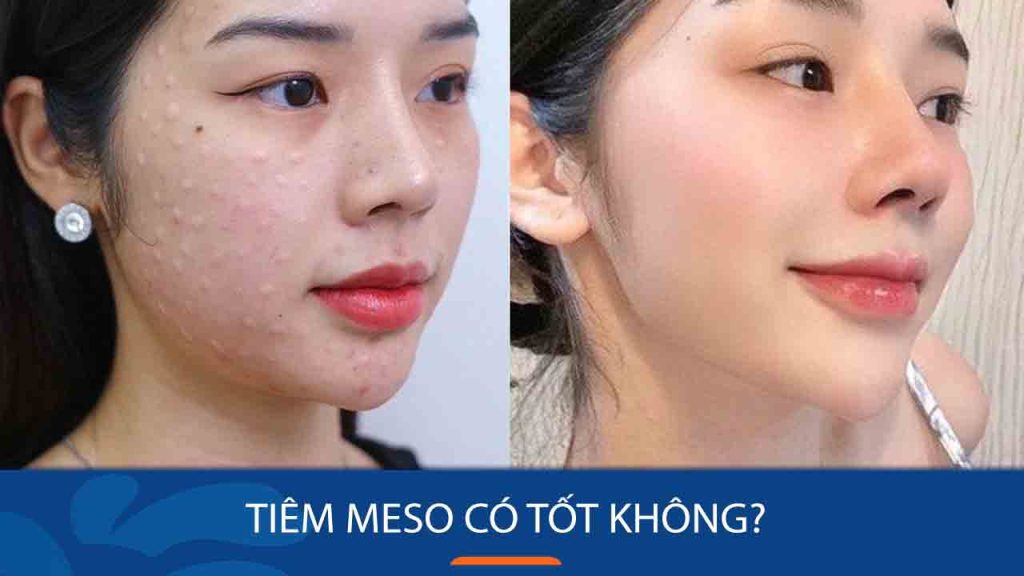 Tiêm meso có tốt không? Cần lưu ý điều gì