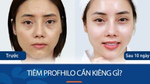 Tiêm Profhilo cần kiêng gì? 5 điều tuyệt đối nên tránh sau tiêm