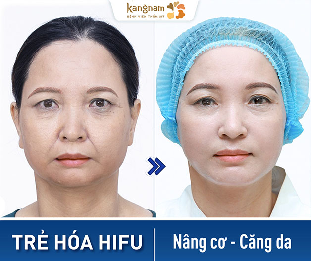Căng da mặt bằng công nghệ Hifu