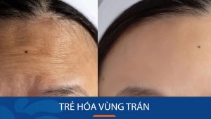 Trẻ hóa vùng trán – Giải pháp hoàn hảo cho da lão hóa