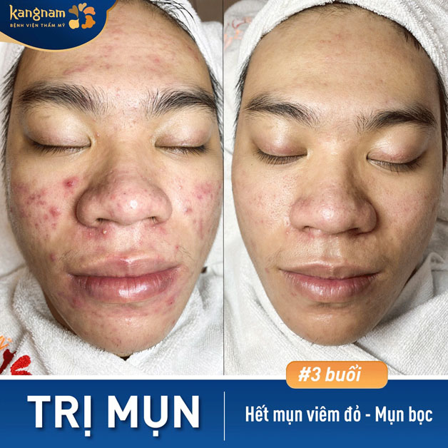 Khách hàng nam lấy lại làn da chắc khỏe sau khi trị mụn viêm