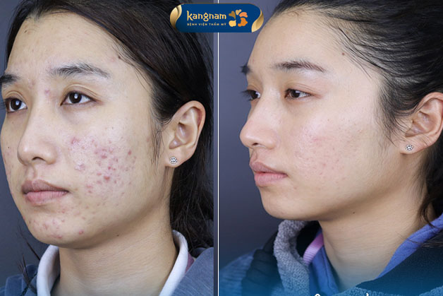Mụn viêm nang nặng đến mấy Kangnam cũng có thể giải quyết triệt để
