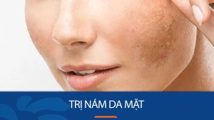 Tại sao nám hình thành trên da mặt? 10 Cách trị nám da mặt hiệu quả