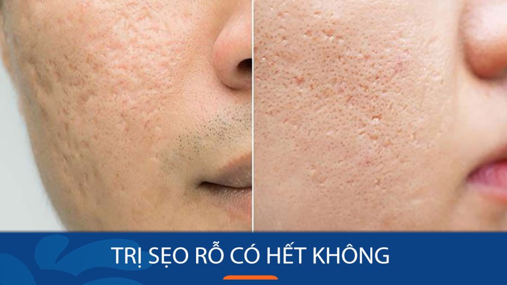 Trị sẹo rỗ có hết không? Các phương pháp hiệu quả và an toàn
