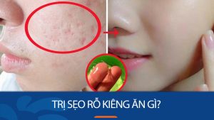 Trị sẹo rỗ kiêng ăn gì? Danh sách 10+ thực phẩm đại kỵ khi trị sẹo rỗ