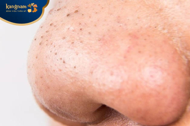 Tại sao mụn đầu đen thường xuất hiện ở mũi?