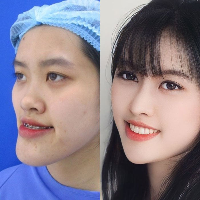 Chỉnh hàm móm Kangnam – Tạo khớp cắn chuẩn, giải quyết vĩnh viễn