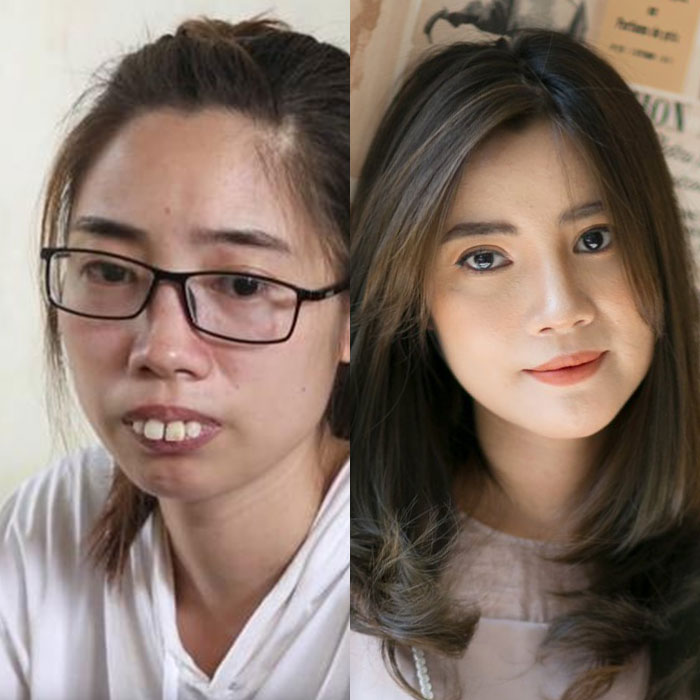 Chỉnh hàm hô – Chỉnh sửa hết hô, mặt tự nhiên