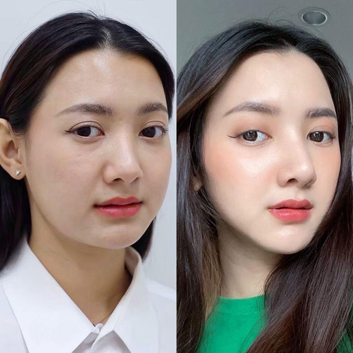 Thu gọn góc hàm Vline – Góc mặt đẹp tự nhiên, viền hàm thon gọn