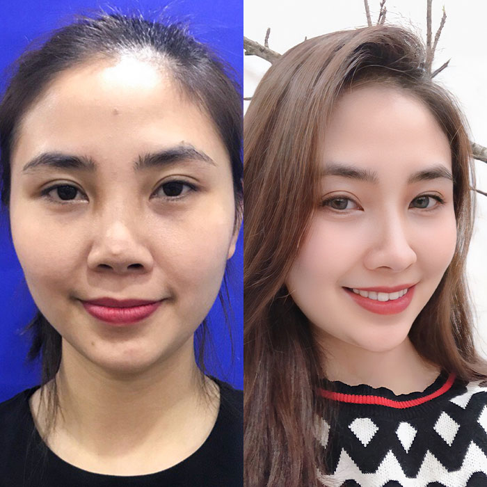 Giải cứu mũi hỏng – Cơ hội thứ 2 cho chiếc mũi