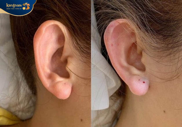 Tiêm dái tai lộc duy trì được trong cơ thể từ 6 - 24 tháng