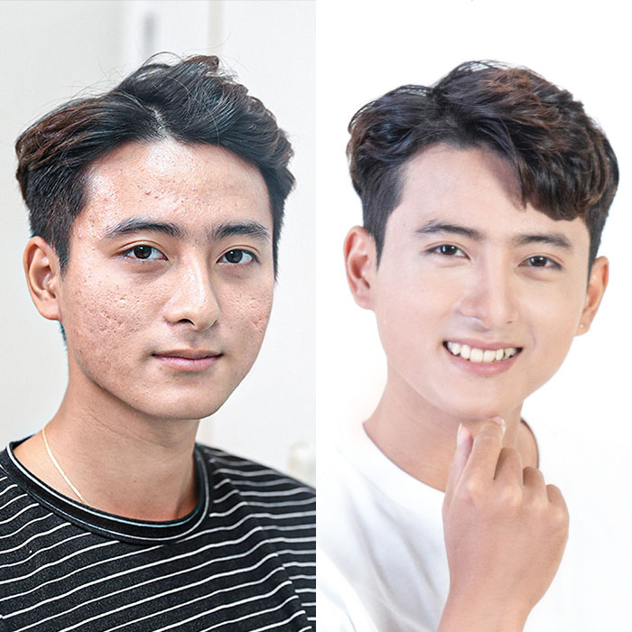 Công nghệ trị sẹo tân tiến, hiện đại tại Kangnam – Hiệu quả tức thì, sạch sẹo