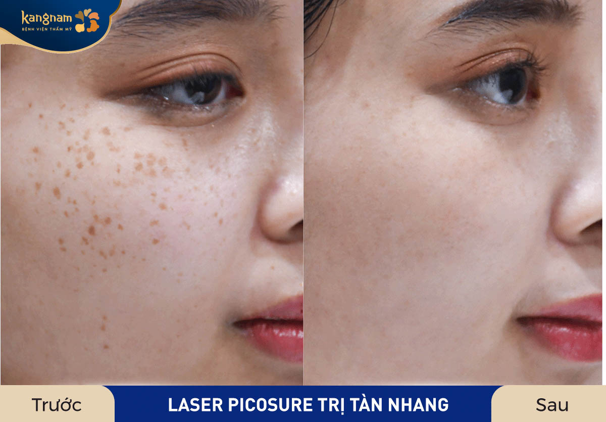 Ứng dụng công nghệ Laser Picosure giúp khách hàng tạm biệt tàn nhang nhanh chóng