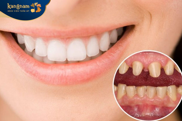 Bọc mão sứ thẩm mỹ giúp khôi phục chức năng của răng, mang đến nụ cười rạng rỡ