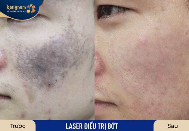 Làn da có sự cải thiện đáng kể sau trị bớt bằng laser