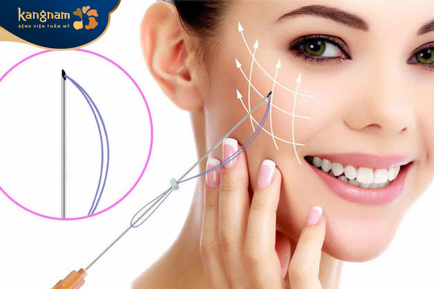 Căng chỉ da mặt bằng collagen là phương pháp không đòi hỏi can thiệp dao kéo